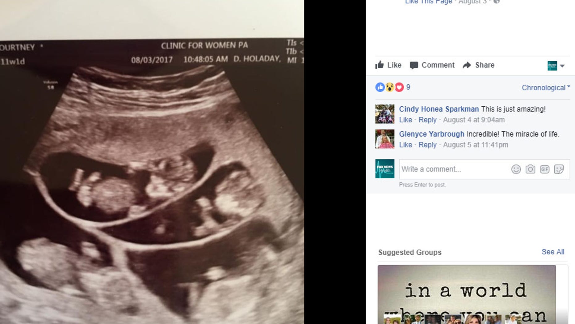 Mom Of 3 Shocked To Learn Shes Expecting Sextuplets Fox News