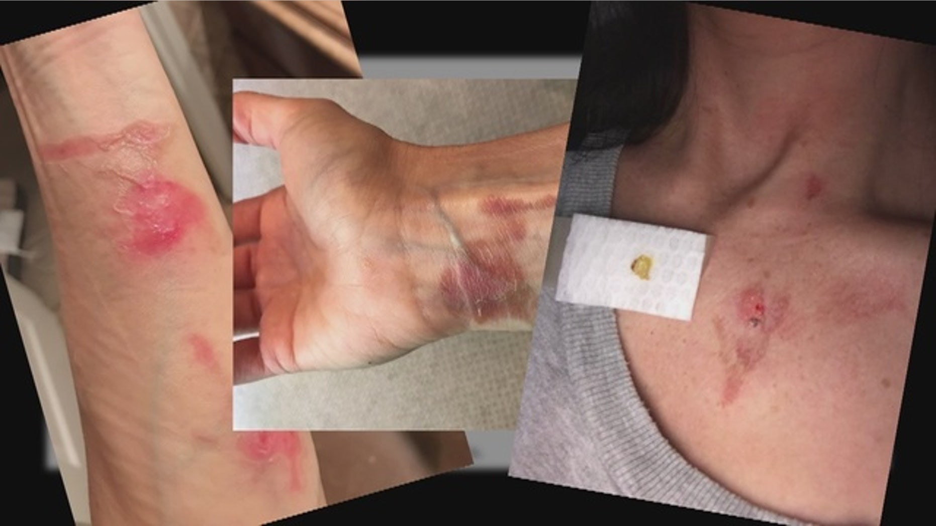 Sheryl Utal claims she sustained the above injuries while using her "NutriBullet" for 15-20 seconds.