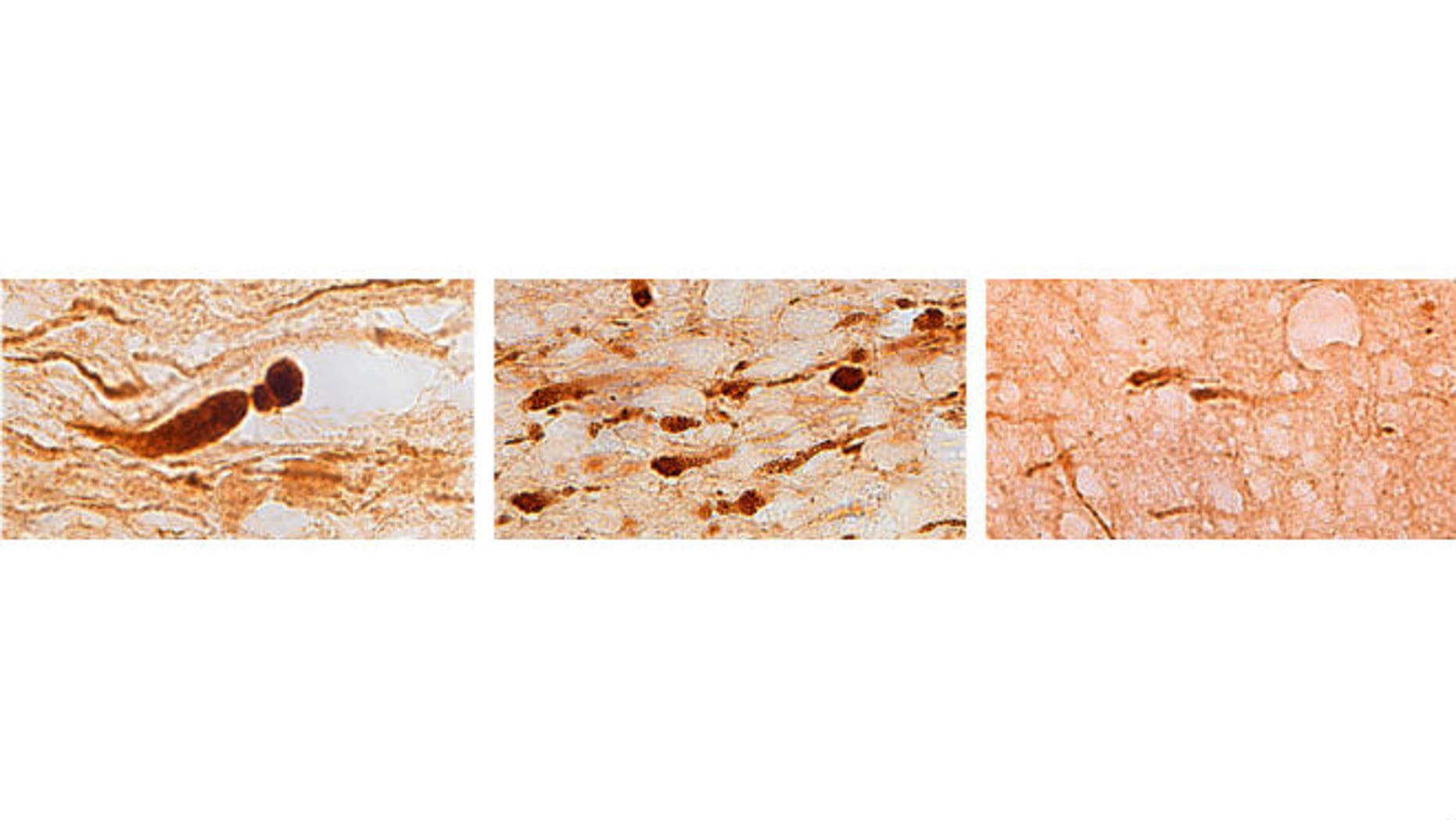 Brain sections from three different individuals show (left) axons with large, bulb-shaped lesions characteristic of a motor vehicle crash; (center) many smaller lesions characteristic of a blast injury; and (right) fewer lesions characteristic of an opiate overdose. (Credit: Vassilis Koliatsos)