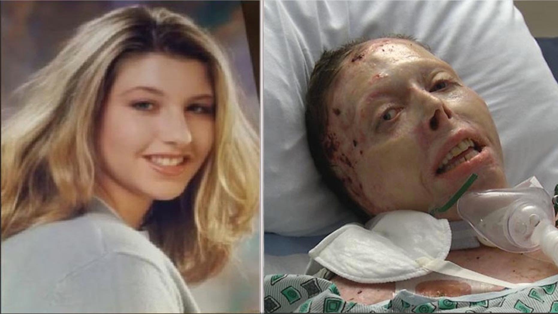 Judy Malinowski is shown before her death and after she was burned over over 80 percent of her body.