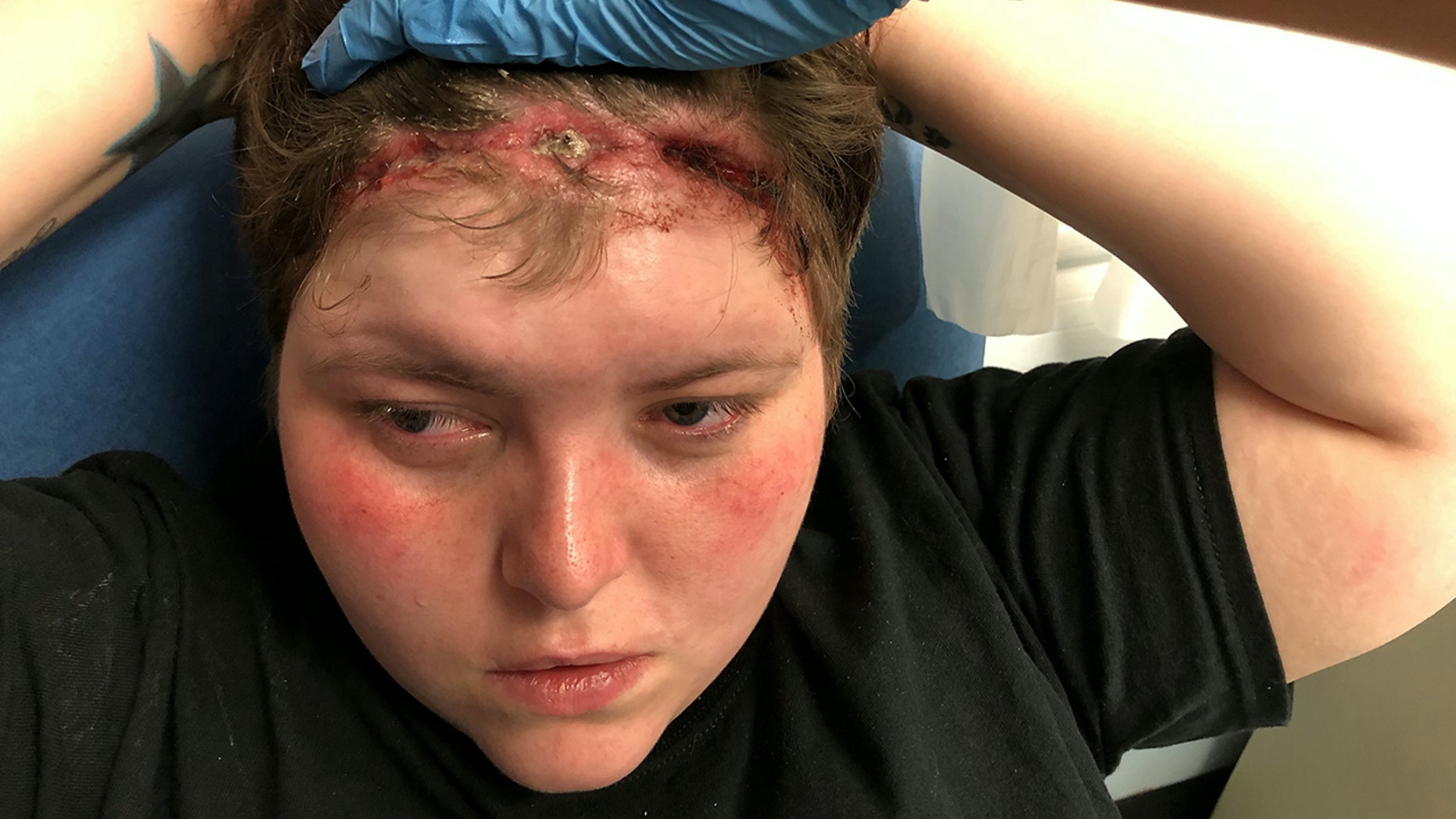 Helzie Amnell-Connor may be permanently scarred after getting a weave threaded into her hair that was too tight.