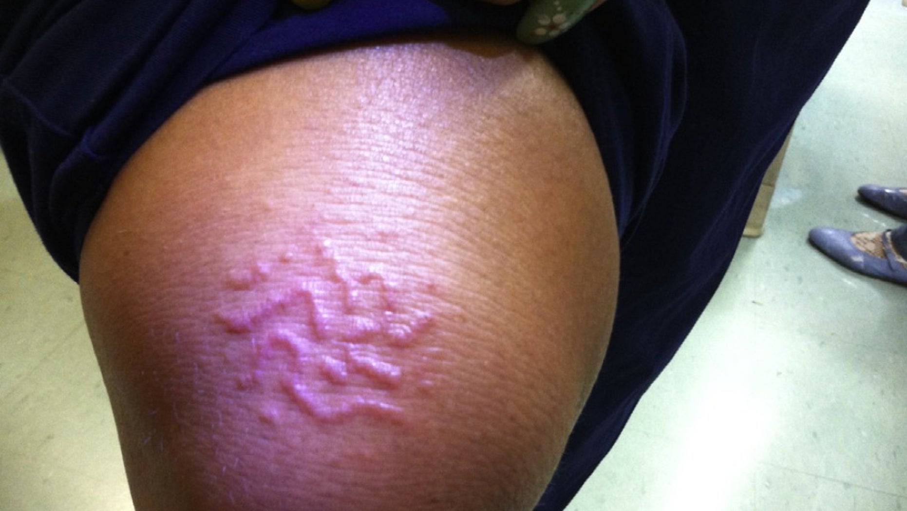 The itchy rash on the woman's knee had a raised, snake-like appearance.
