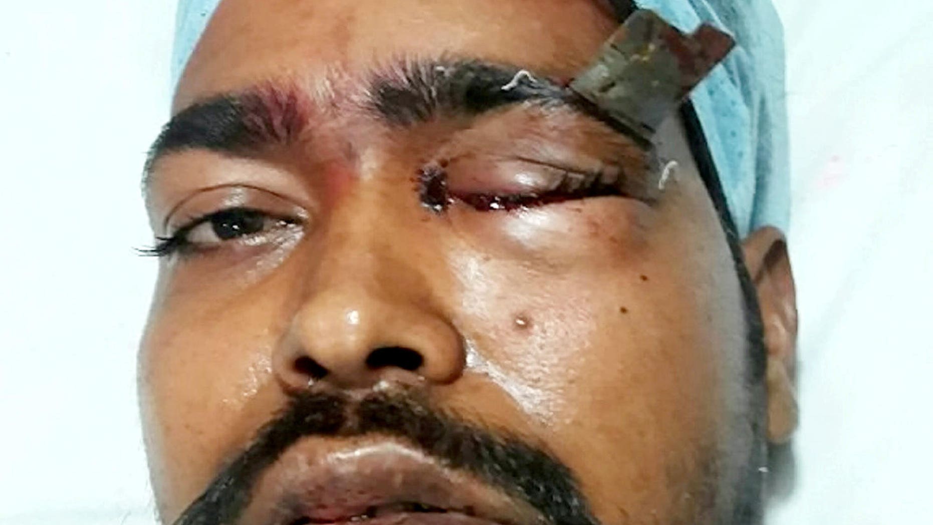Ashok Nirmalkar was stabbed so hard in the eyebrow that the handle snapped off, leaving a 3-inch blade embedded in his skull.