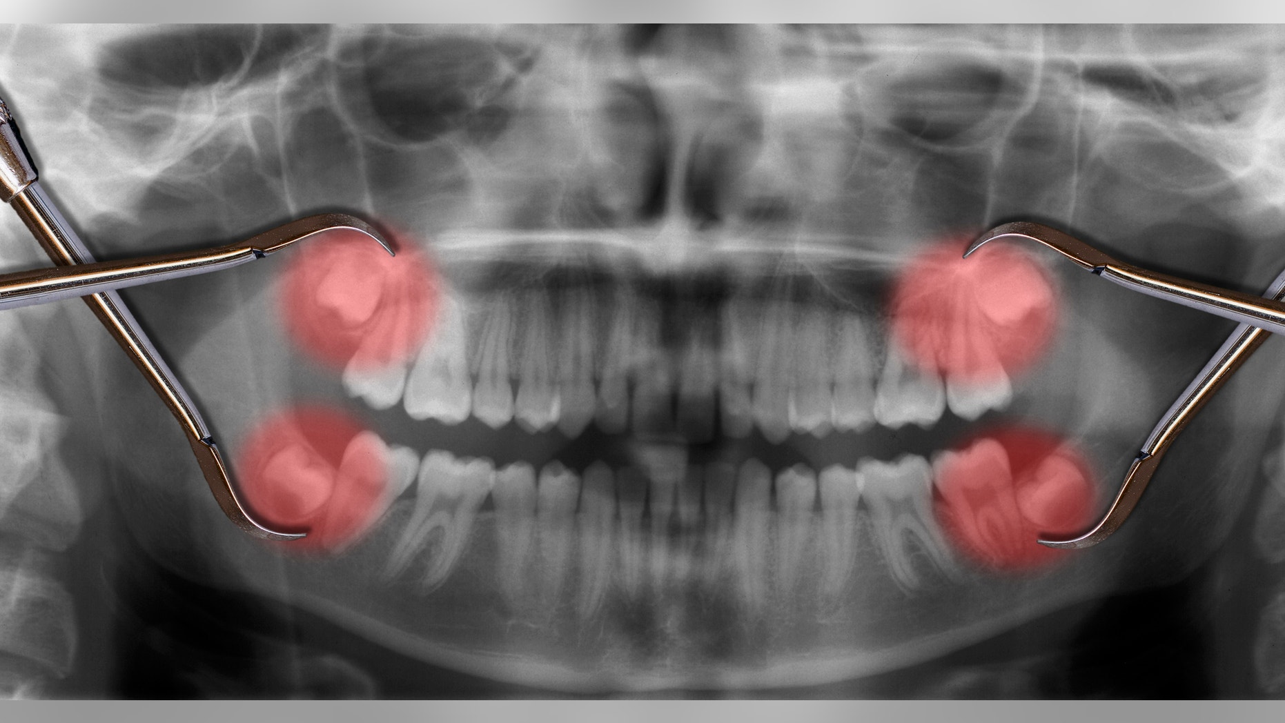 display four wisdom teeth over x-ray