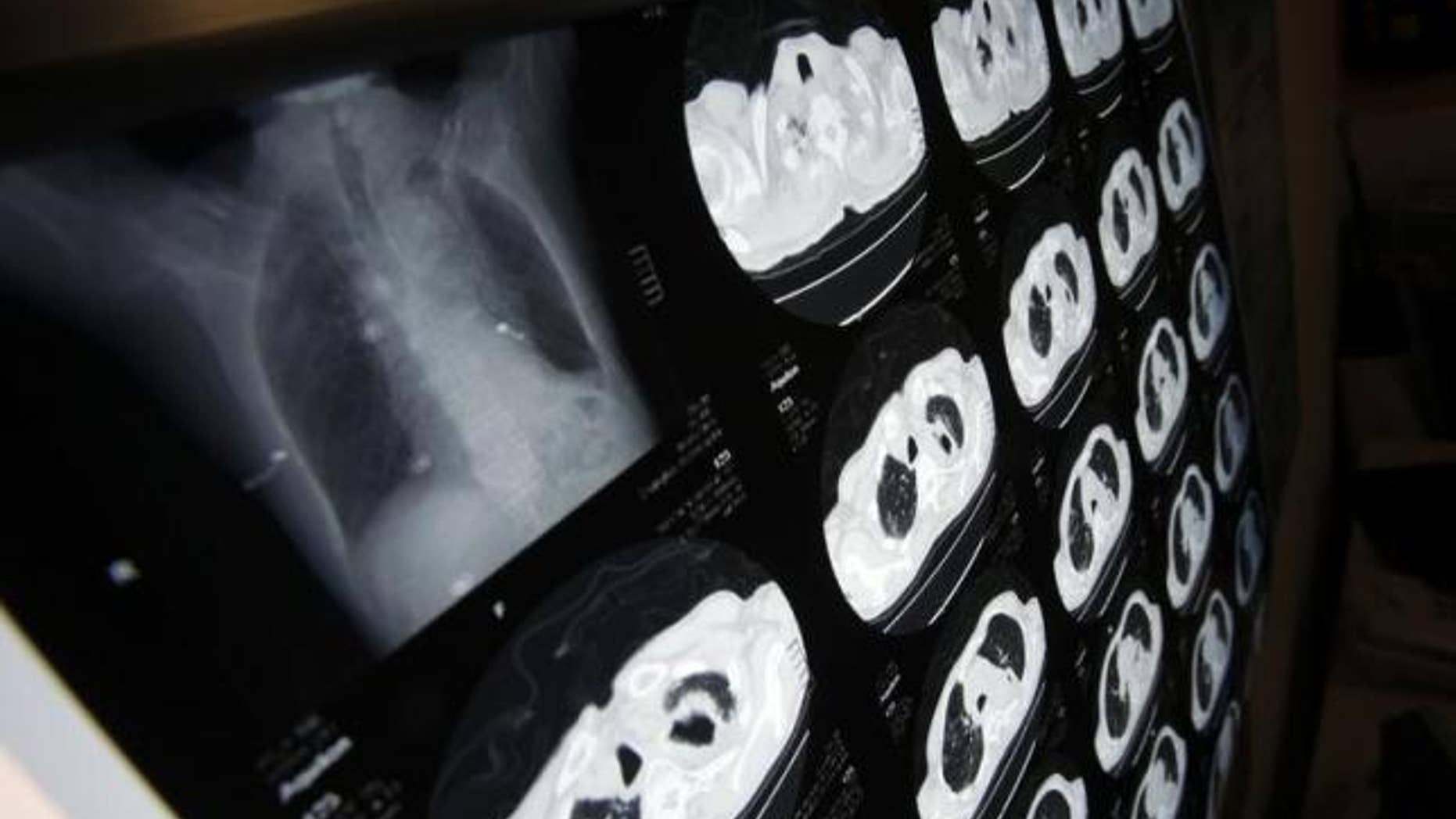 April 27, 2011: A X-ray of a patient with a lung tumour caused by smoking is seen at Ruijin Hospital in Shanghai.