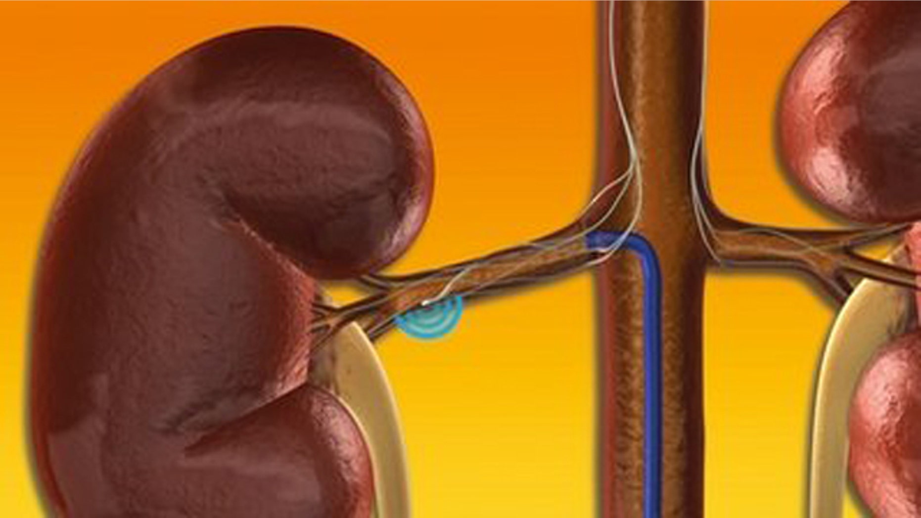 This illustration provided by Ardian's Symplicity Catheter System shows the Symplicity Catheter System, which delivers low-power RF energy to deactivate the renal sympathetic nerves.