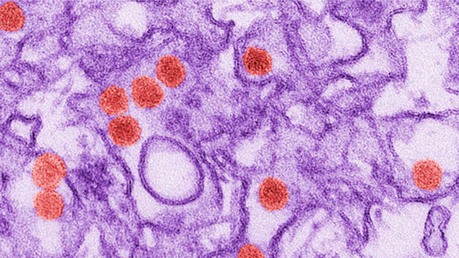 FILE - This 2016 digitally-colorized electron microscope image made available by the Centers for Disease Control and Prevention shows the Zika virus, in red, about 40 nanometers in diameter. On Friday, Aug. 26, 2016, U.S. health officials reported the first case of Zika spread through sex by a man who had no symptoms of the disease. In other cases of sexual transmission, the virus was spread by someone who at some point had symptoms. The Maryland man went to the Dominican Republic, where there is a Zika outbreak. He didnt get sick but his sex partner did and recovered. (Cynthia Goldsmith/CDC via AP)