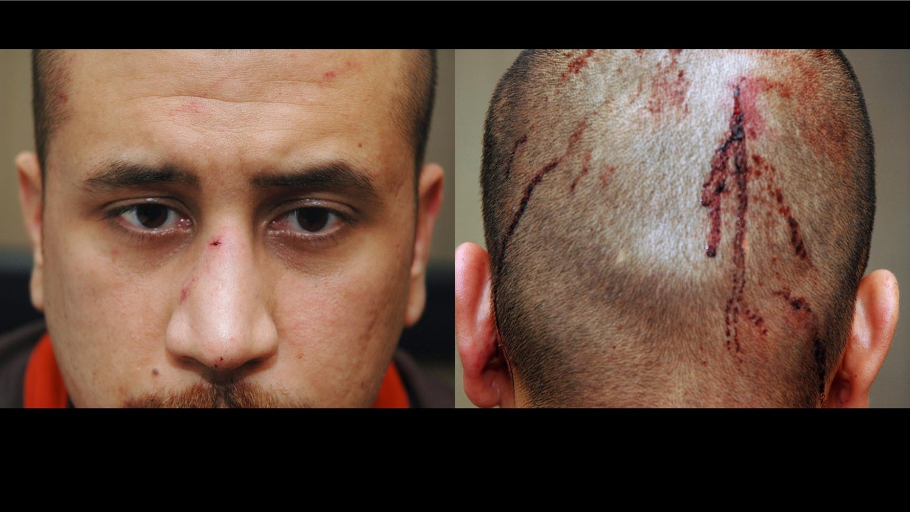 Feb 27: Photo released by the State Attorney's Office shows George Zimmerman, the neighborhood†watch volunteer who shot Trayvon Martin, with blood on the back of his head.