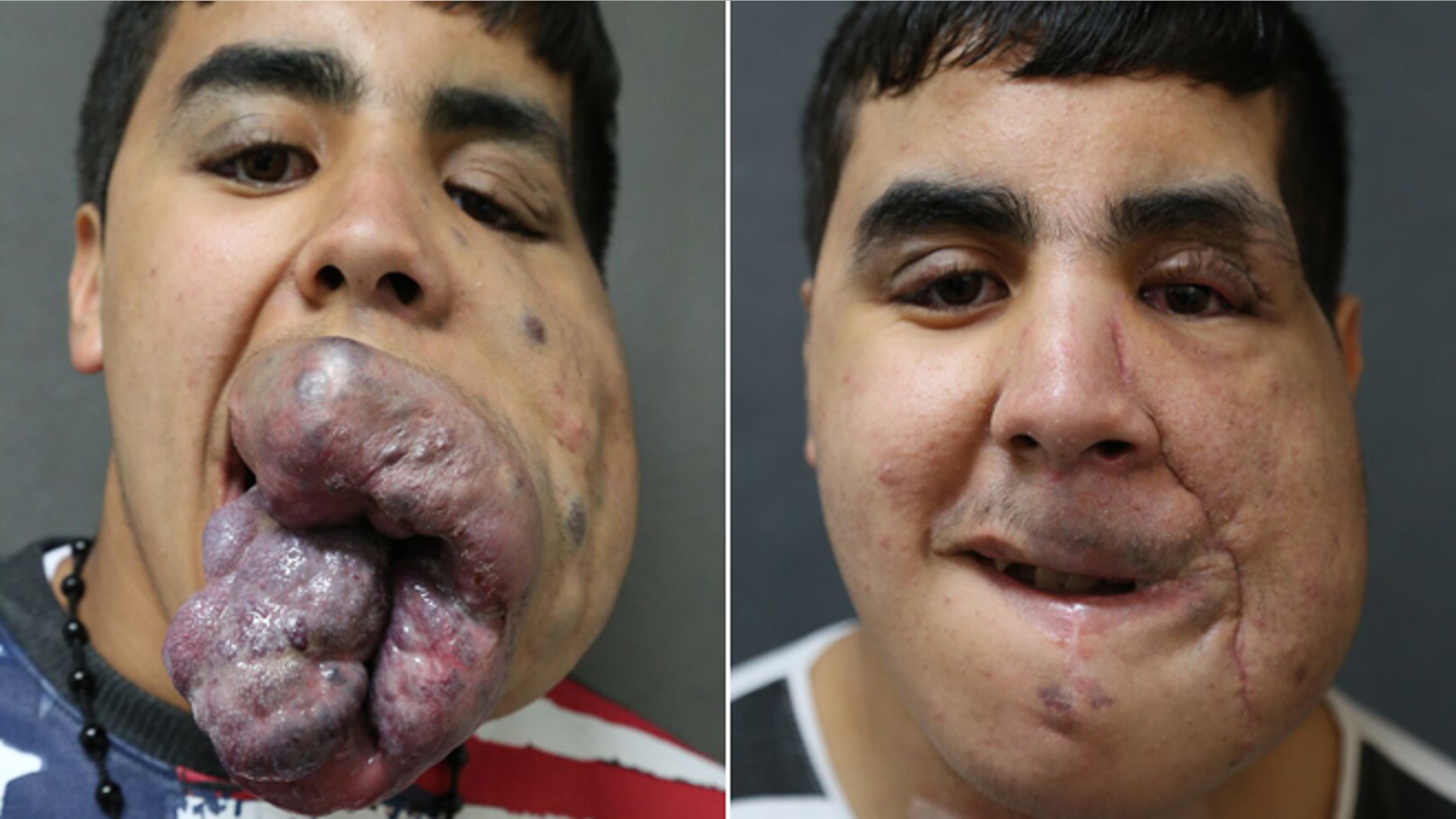 Zoubir Lahdodi, 18, was born with venus malformation, which threatened his ability to eat, breathe, speak and sleep. Lenox Hill Hospital surgeons performed seven surgeries to help correct the potentially fatal disorder.