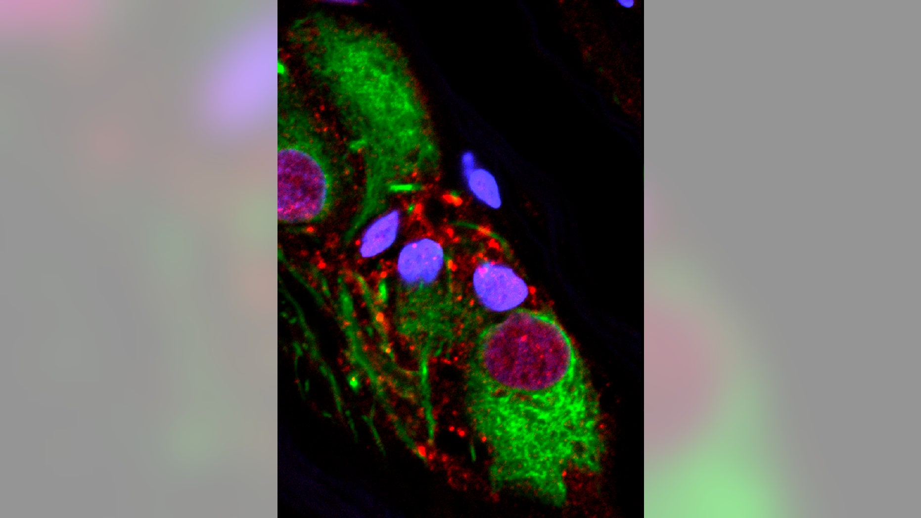 This microscope image provided by the Van Andel Research Institute in October 2018 shows an abnormal protein that is a hallmark of Parkinson’s disease clumped inside the appendix.