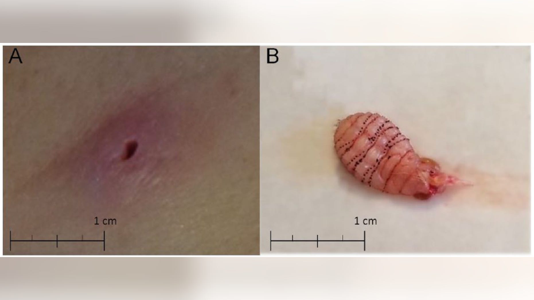 The image on the left shows the lesion on the woman’s skin. The image on the right shows the larva after it was removed. The rows of black spines make it difficult to extract.