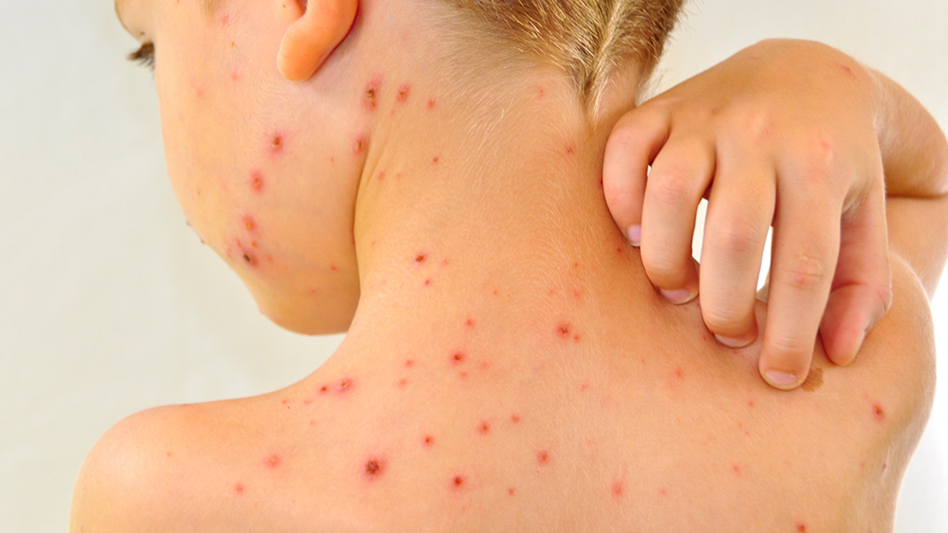 Chickenpox outbreak is North Carolina's largest since 1995