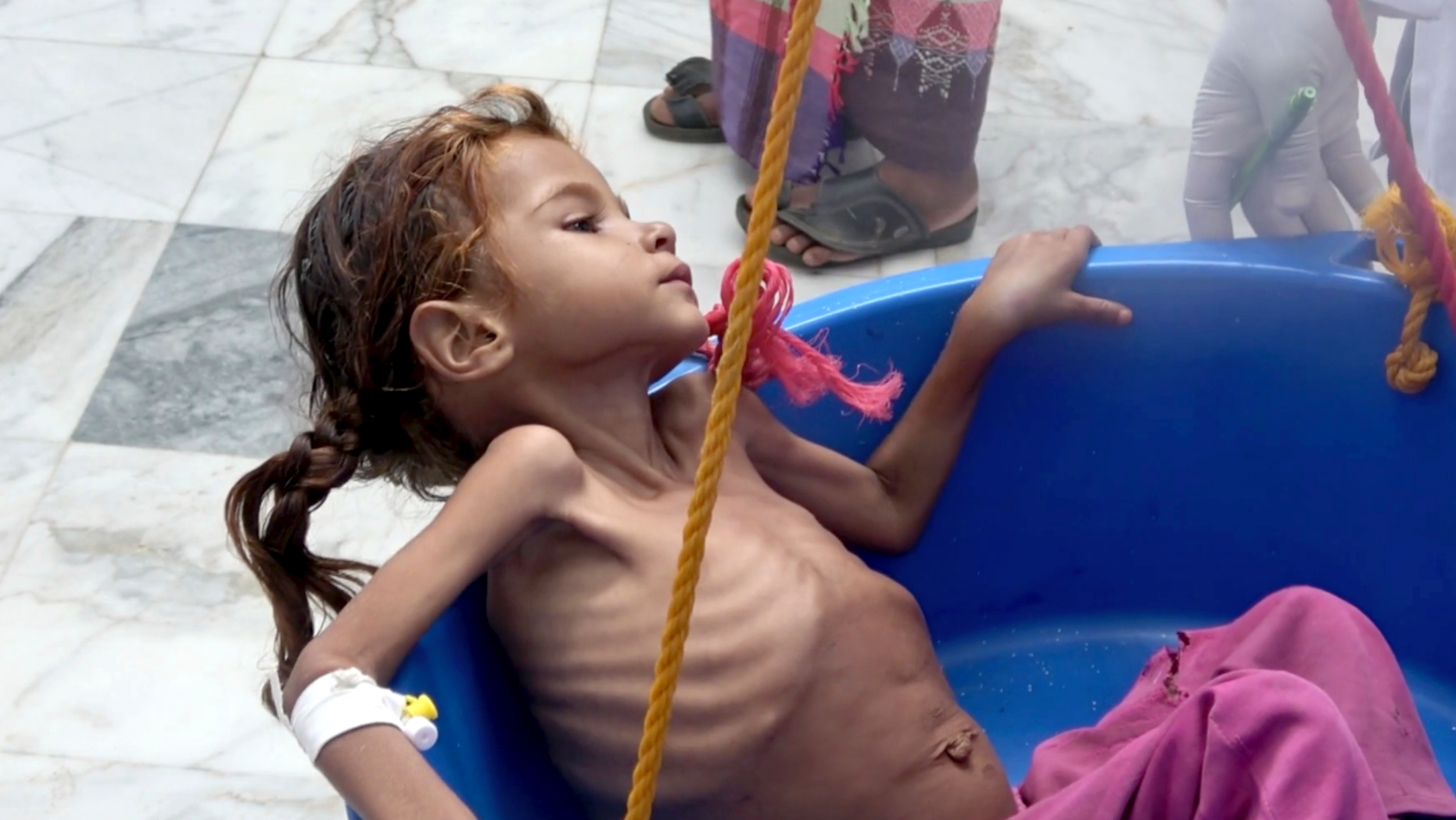 FILE - In this Aug. 25, 2018 file image made from video, a severely malnourished seven-year-old Amal Hussein — whose name means "hope" in Arabic, is weighed at the Aslam Health Center in Hajjah, Yemen. On Sunday, Nov. 4, 2018, Geert Cappelaere called the situation a "living hell" for all Yemeni children, noting the death of Amal a child whose emaciated body gained attention on the front page of the New York Times last week. In a speech delivered in Amman Cappelaere said, "There is not one Amal — there are many thousands of Amals." (AP Photo/Hammadi Issa, File)