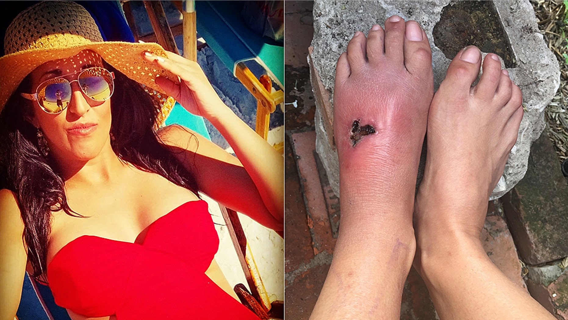 Kelly Kohen, 33, was in shallow water when she felt a pinch on her foot. Days later the wound continued to swell despite receiving antibiotics, and she was diagnosed with flesh-eating bacteria.