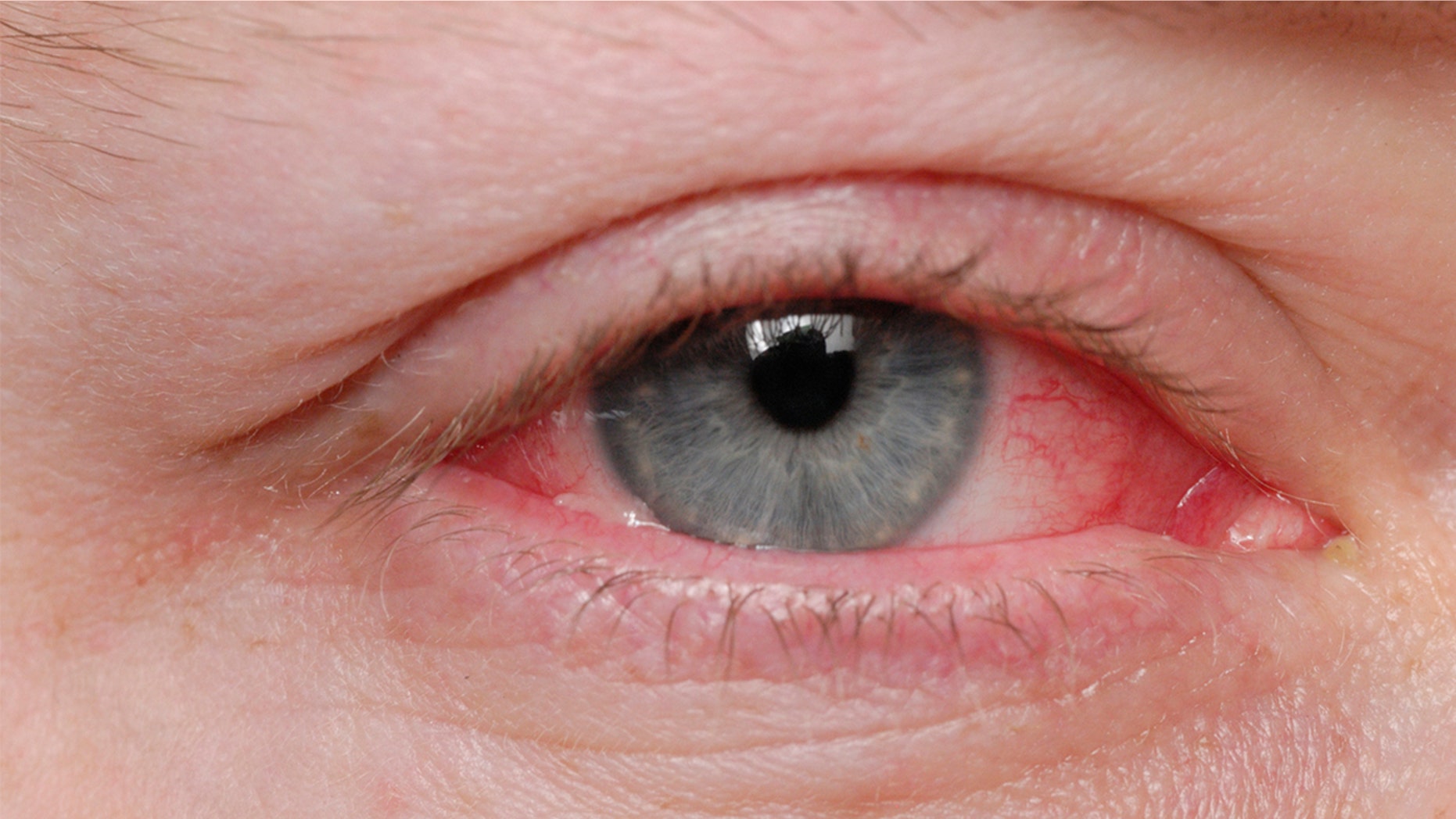 A man in Italy was diagnosed with a rare condition that caused him to bleed from his eyes.