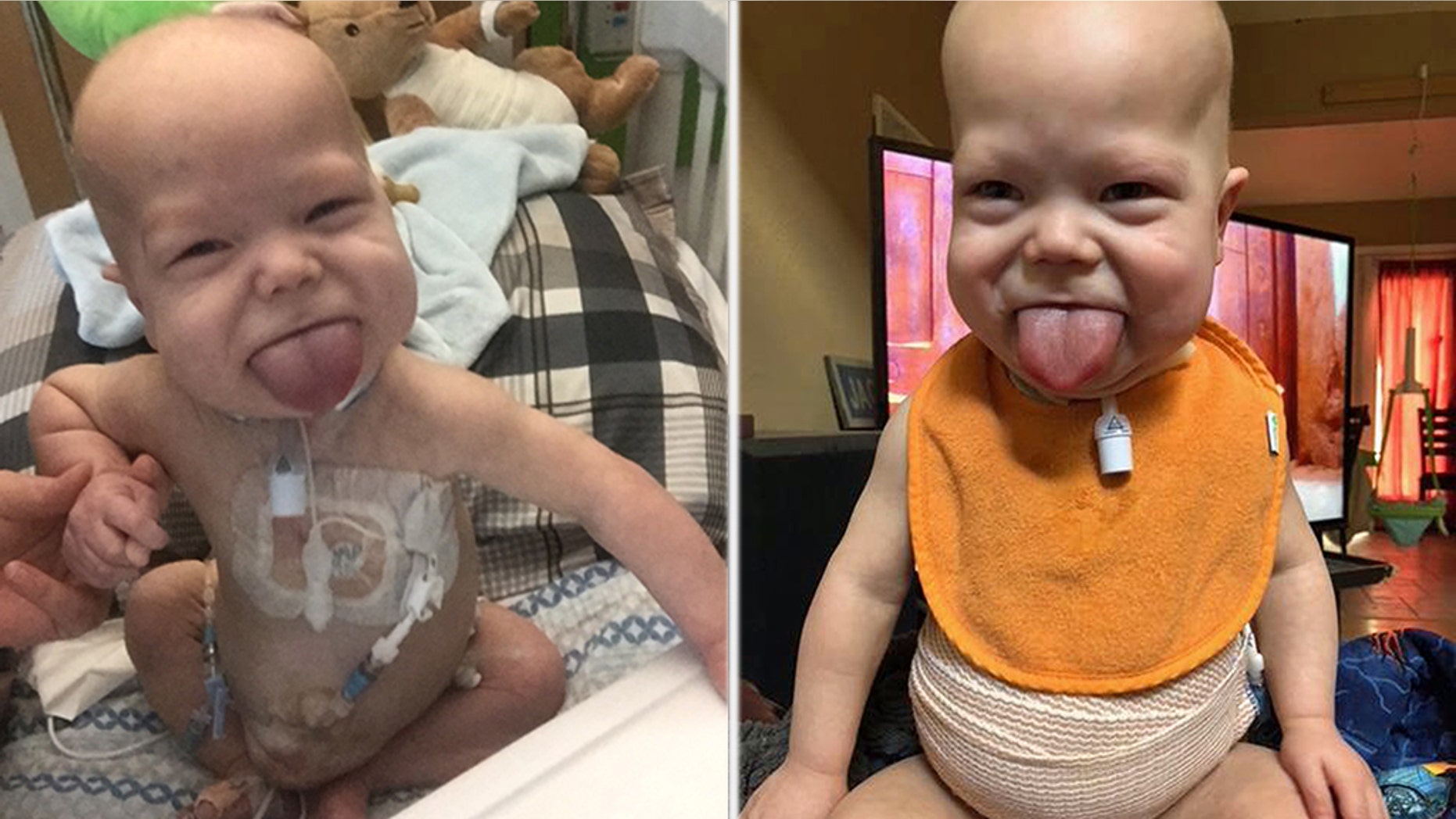 The Oklahoma toddler has a rare condition known as Beckwith-Wiedemann Syndrome, which causes his tongue to be abnormally large. (Caters News Agency)