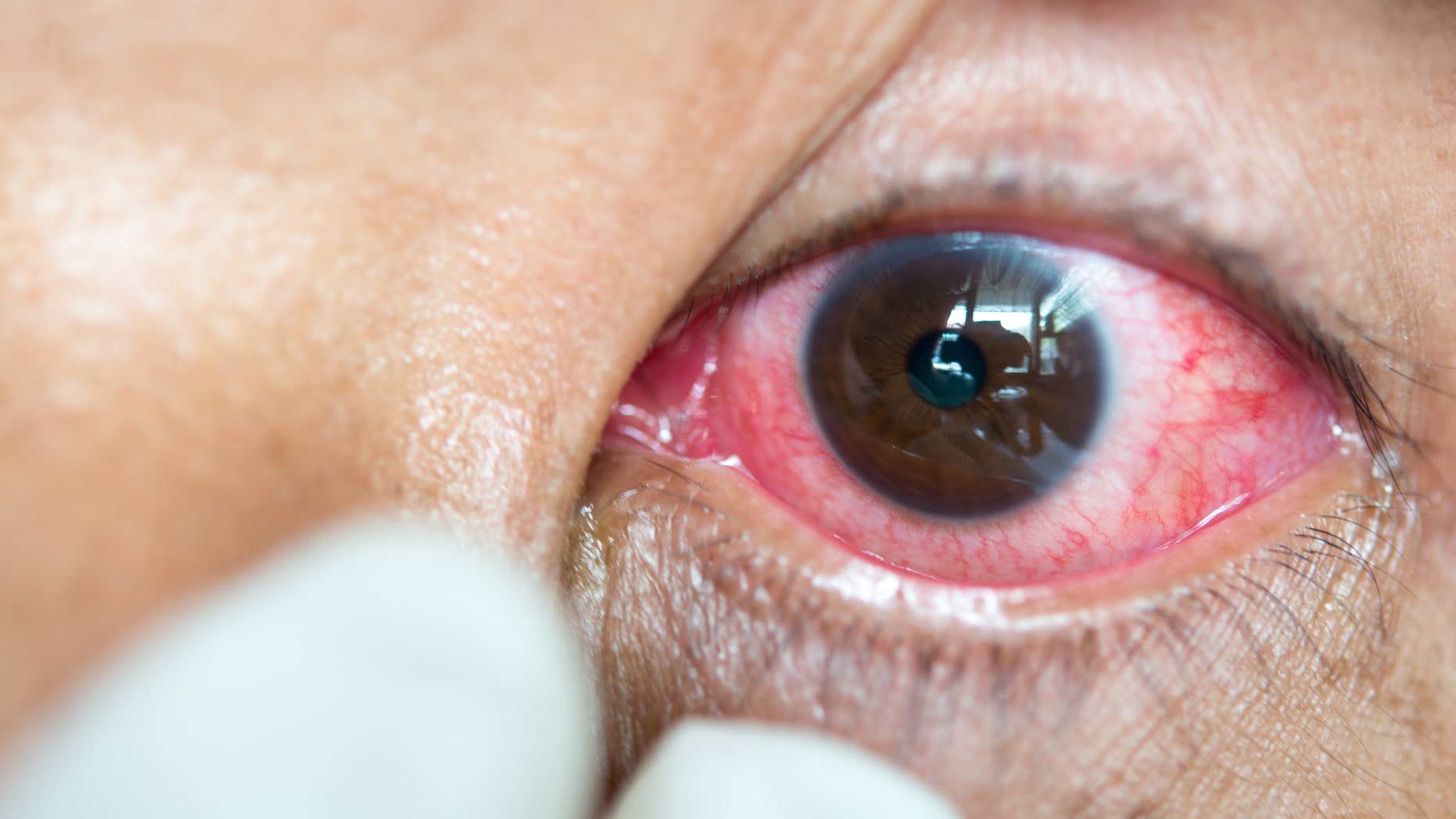 Sleeping in contacts could result in serious eye infections