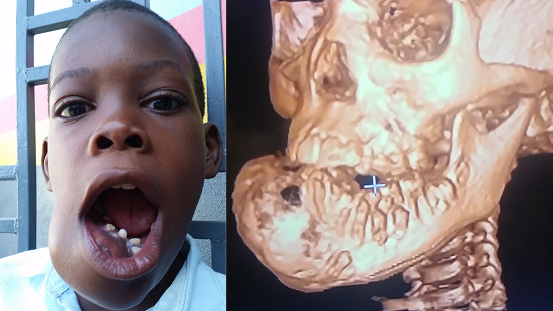 John "Little John" Olivier shows the tumor on his jaw that could not be treated in Haiti, but after a doctor in America agreed to do it pro bono, he got the life-saving surgery in November.