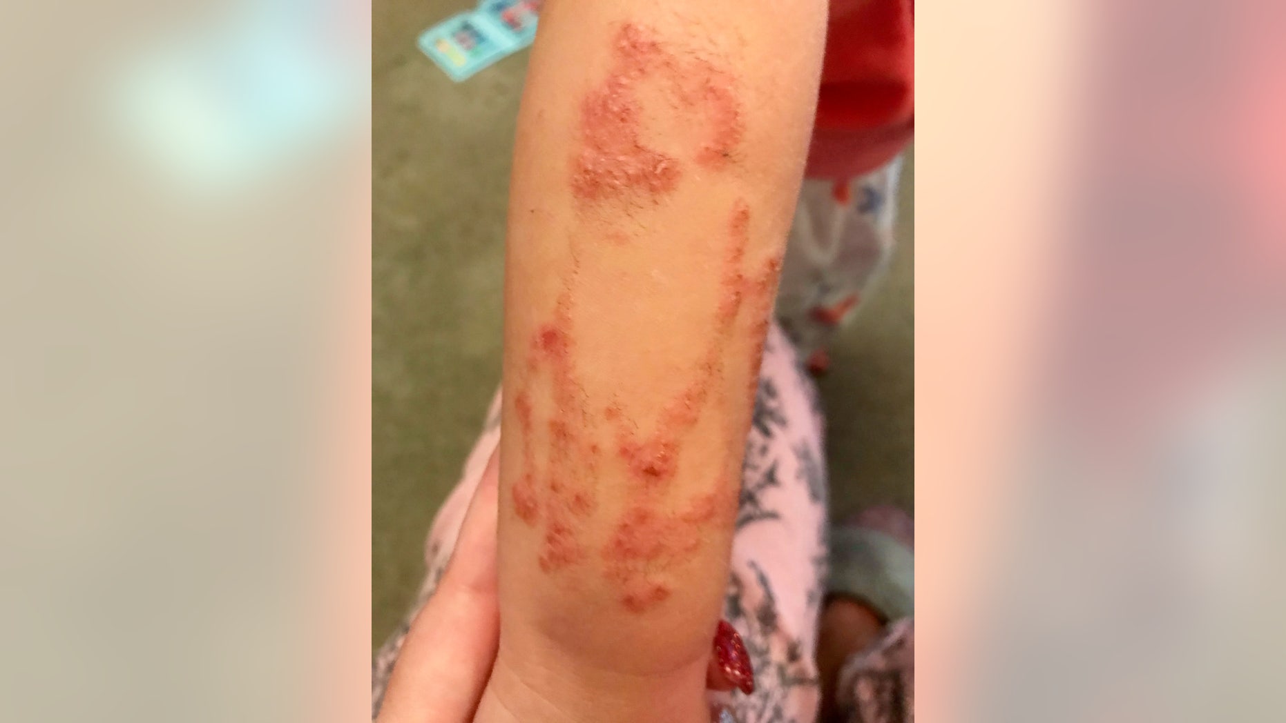 Shortly after returning home from a trip to Turkey, Freja complained the cat henna pattern - which stretched from her wrist to her elbow - was itchy.