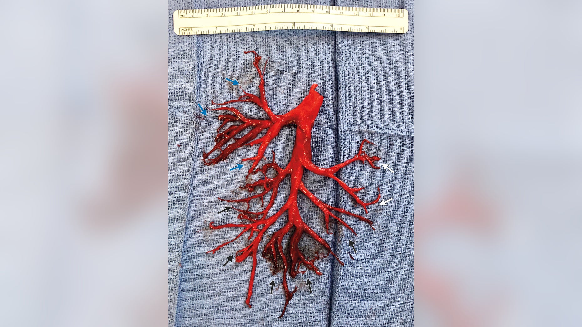 The man had been admitted to the UCSF Medical Center for chronic heart failure, and developed a cough that worsened.