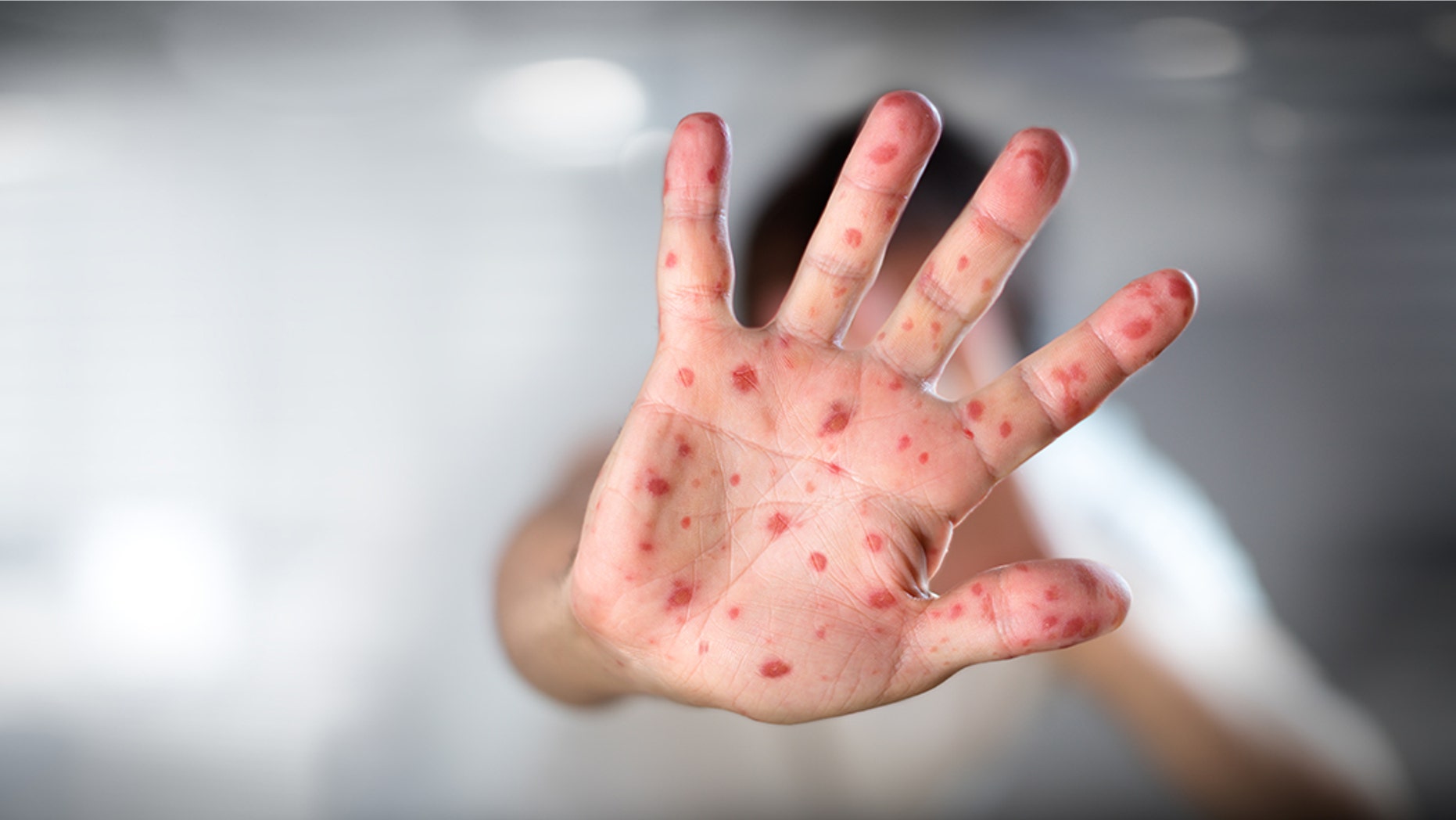 International traveler with measles arrived at New Jersey airport