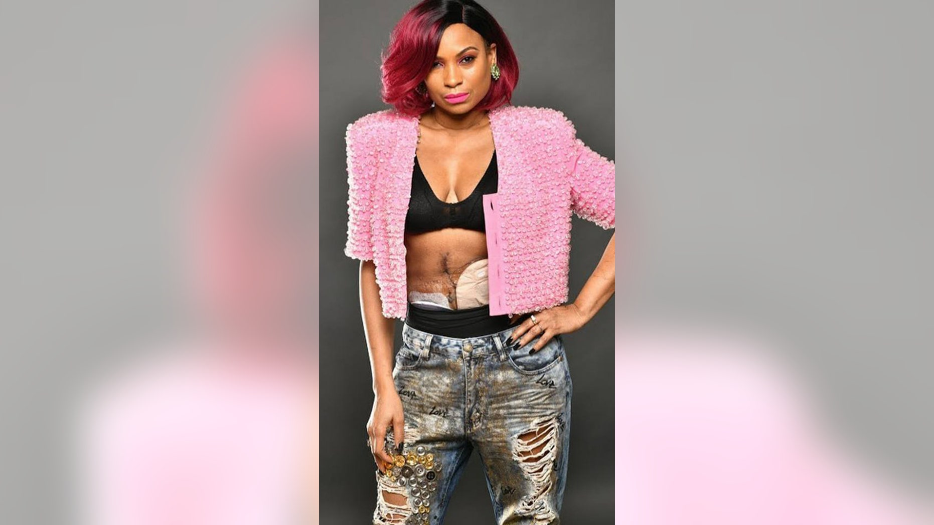 Jearlean Taylor posed with her ostomy bags to motivate others who have survived cancer.