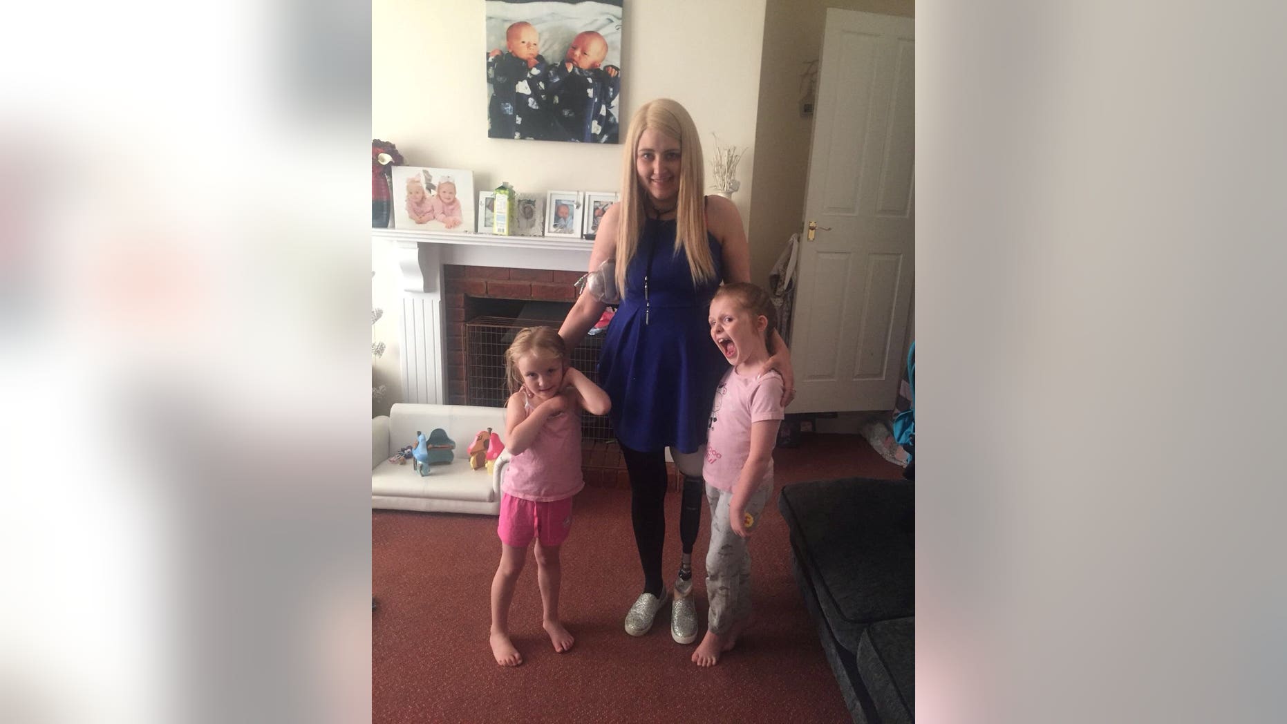 Mom who lost leg to cancer learns to walk again after watching twins take first steps