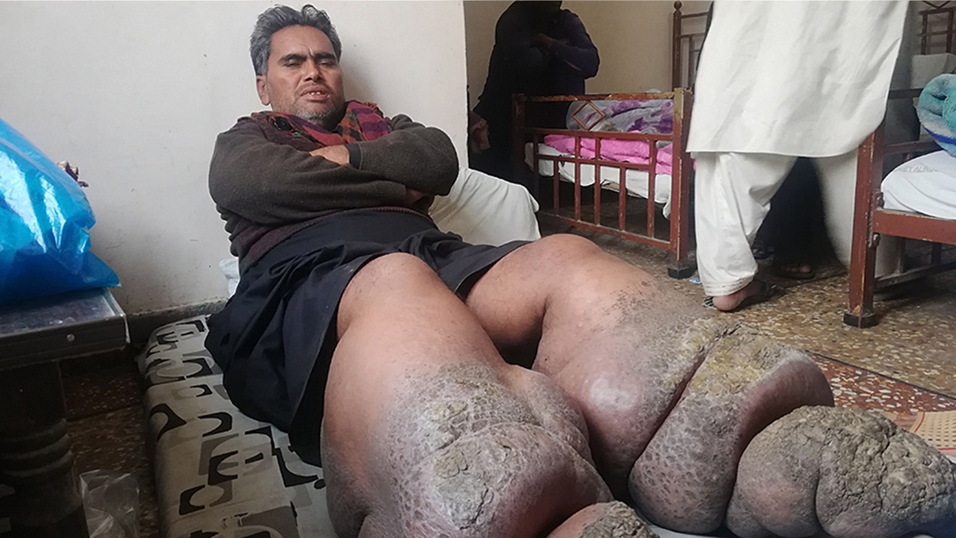 A Pakistani man is turning into stone after a rare condition has caused his legs to swell up more than twice the normal size.