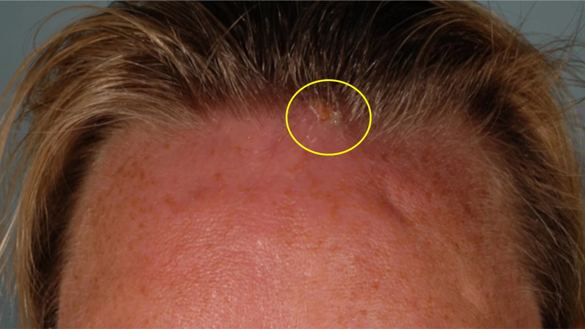 The woman was initially treated for an infected bug bite but when she returned three days later doctors discovered an opening near her hairline.