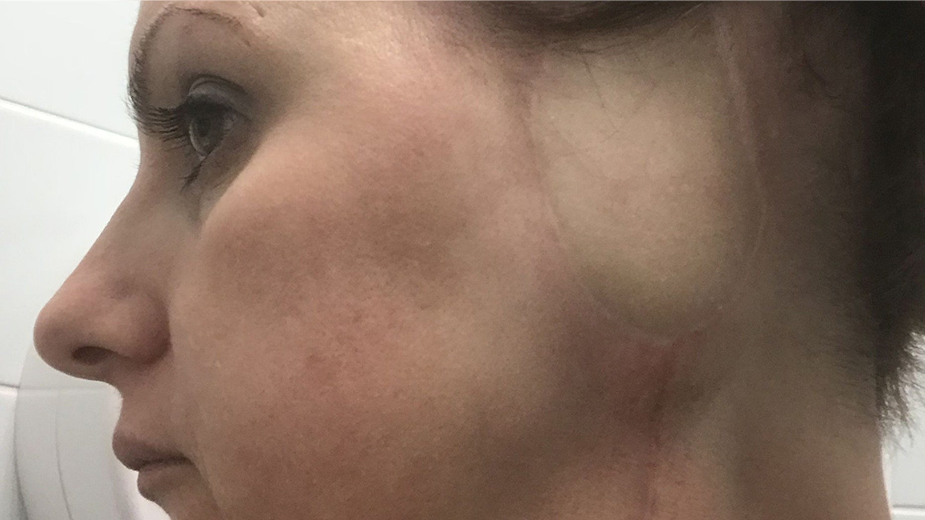 Anthea Smith had her left ear removed after being diagnosed with aggressive skin cancer, and underwent a second surgery to cover up the hole with skin from her thigh.