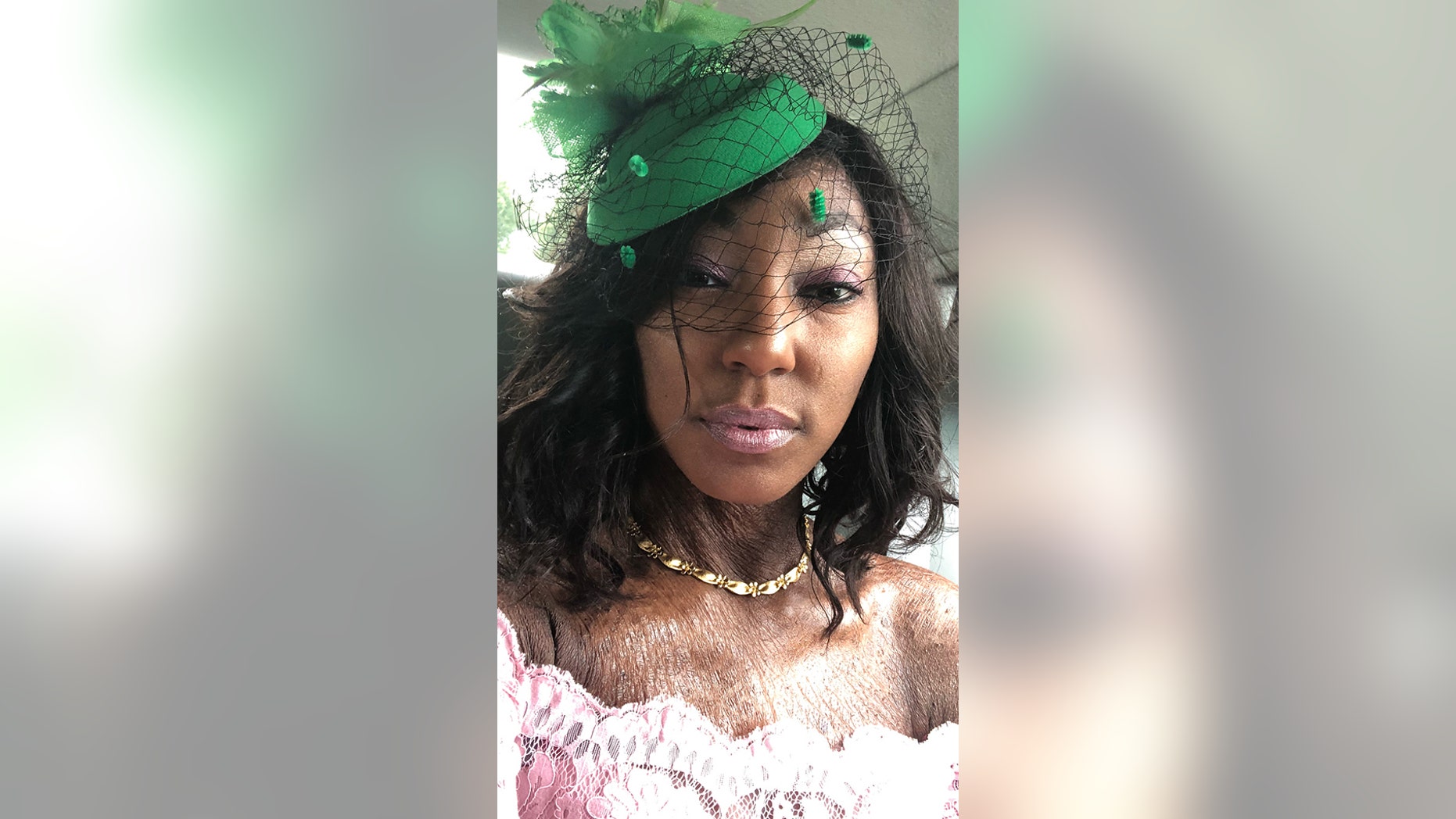 Brittany Mickens, 31, said it wasn't until she was 18 that she finally learned what caused her skin to form a thick scale-like texture.