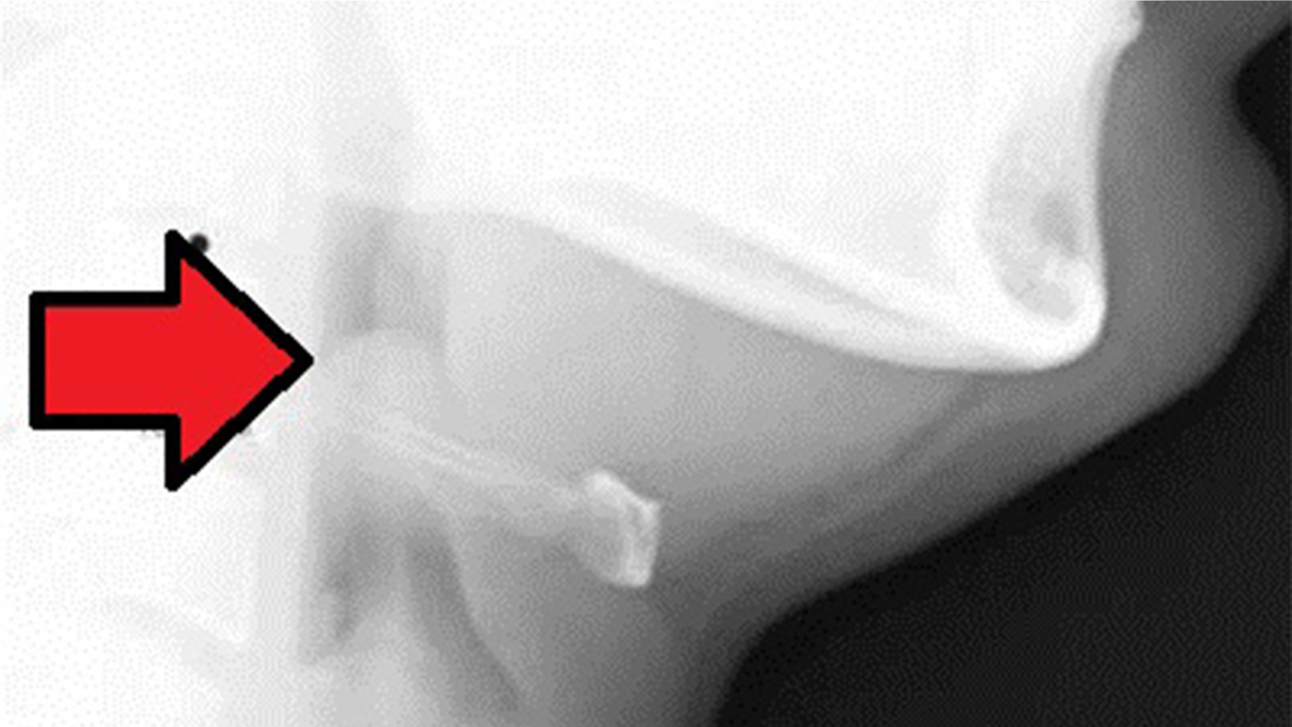 Acute epiglottitis; Side view in x-ray imaging. Lateral soft tissue radiograph reveals