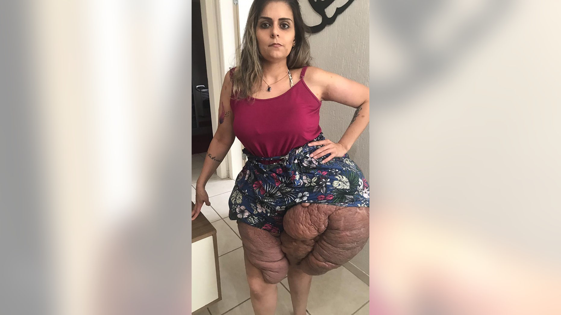 Woman suffering from massive tumors on legs facing incurable disorder
