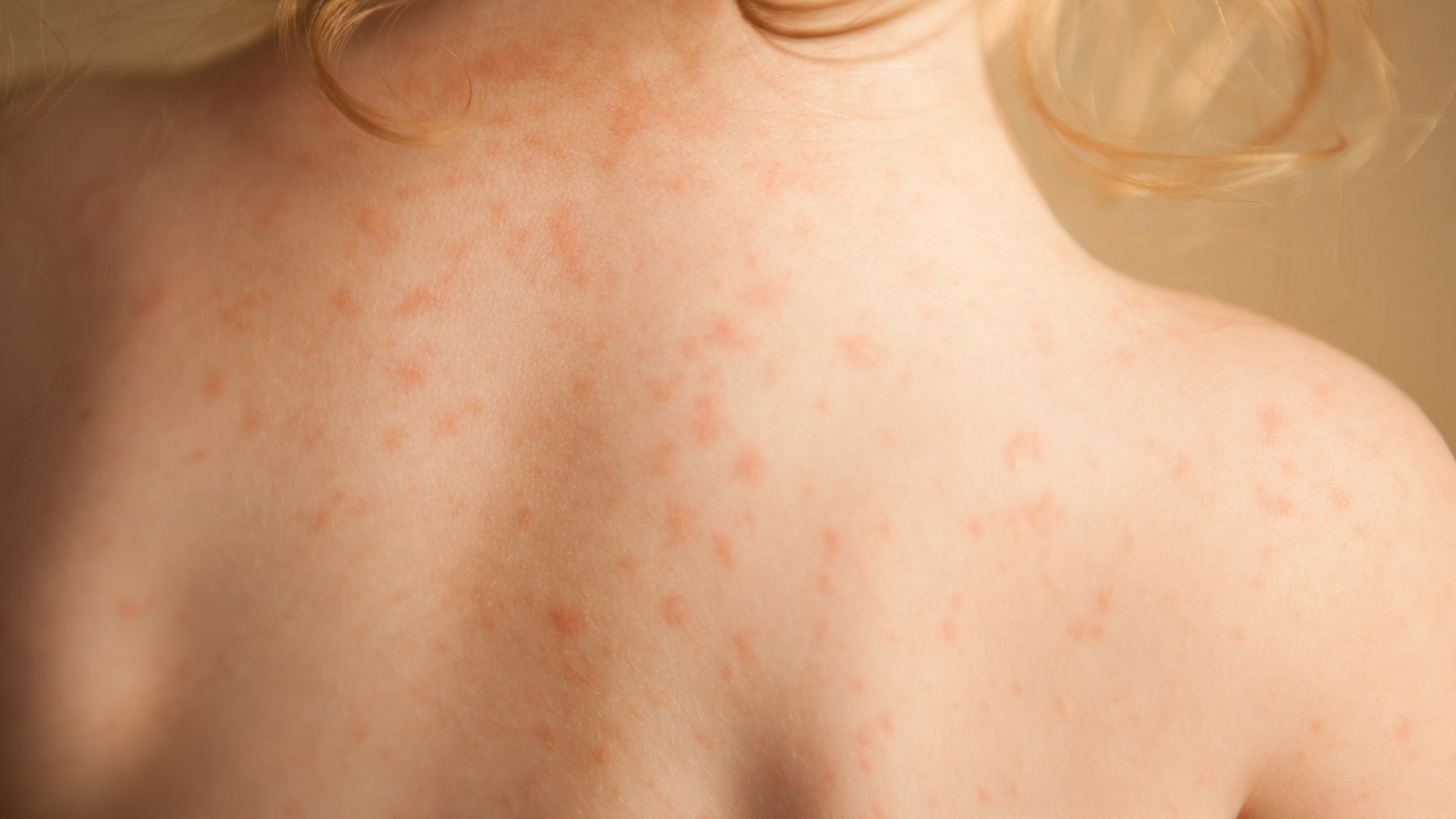 The disease primarily affects children younger than 5 and was first detected in Japan in the 1960s, and then reported in Hawaii in the 1970s.