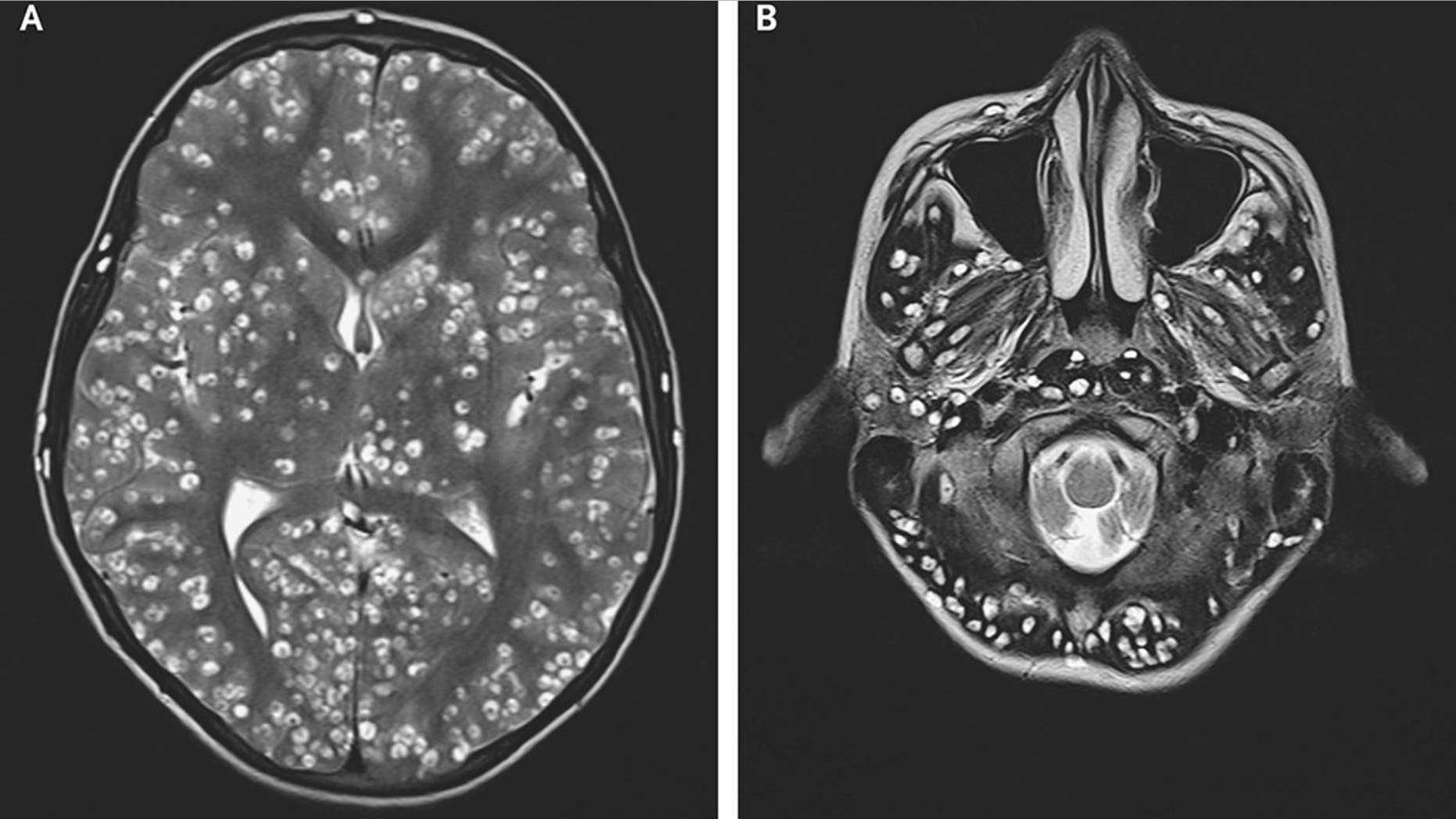 An 18-year-old India man, who was not identified, complained of having pain in his groin and swelling in his eye, was found to have parasites in his brain.<br>