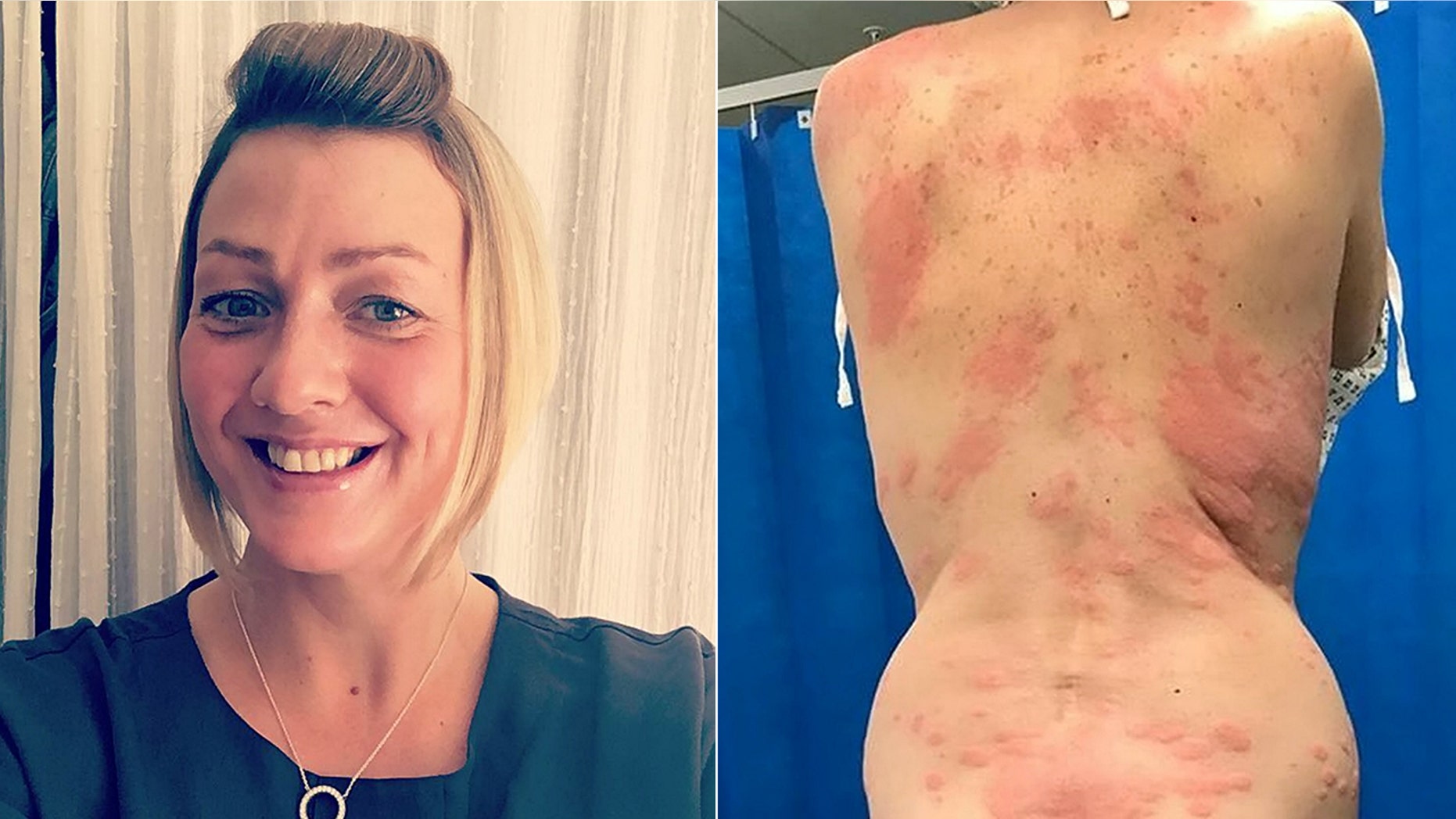 Lisa Santiago-Griggs, 42, said she developed the painful rash after using a vape for the first time.