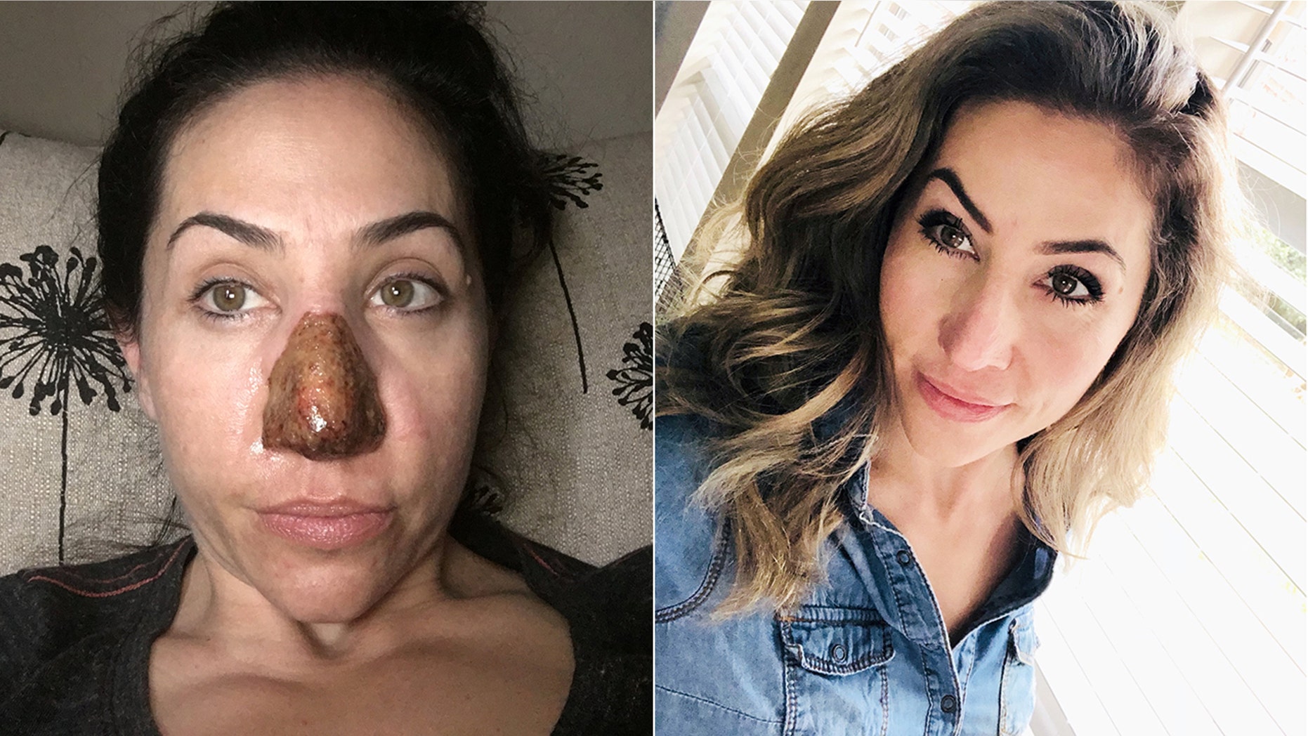 Adrianna Ely had the skin on her nose burned off as part of her treatment plan for a rare condition that caused her nose to morph and double in size.