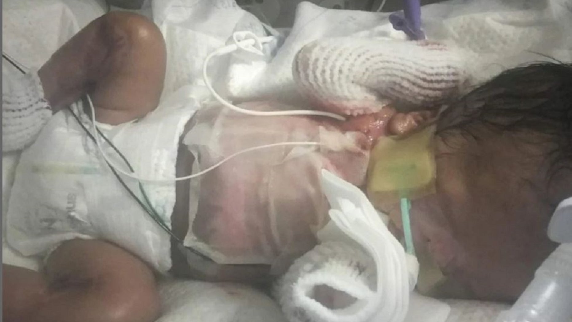 Doctors in Texas are trying to understand what caused Ja’bari Grey to be born without most of his skin.