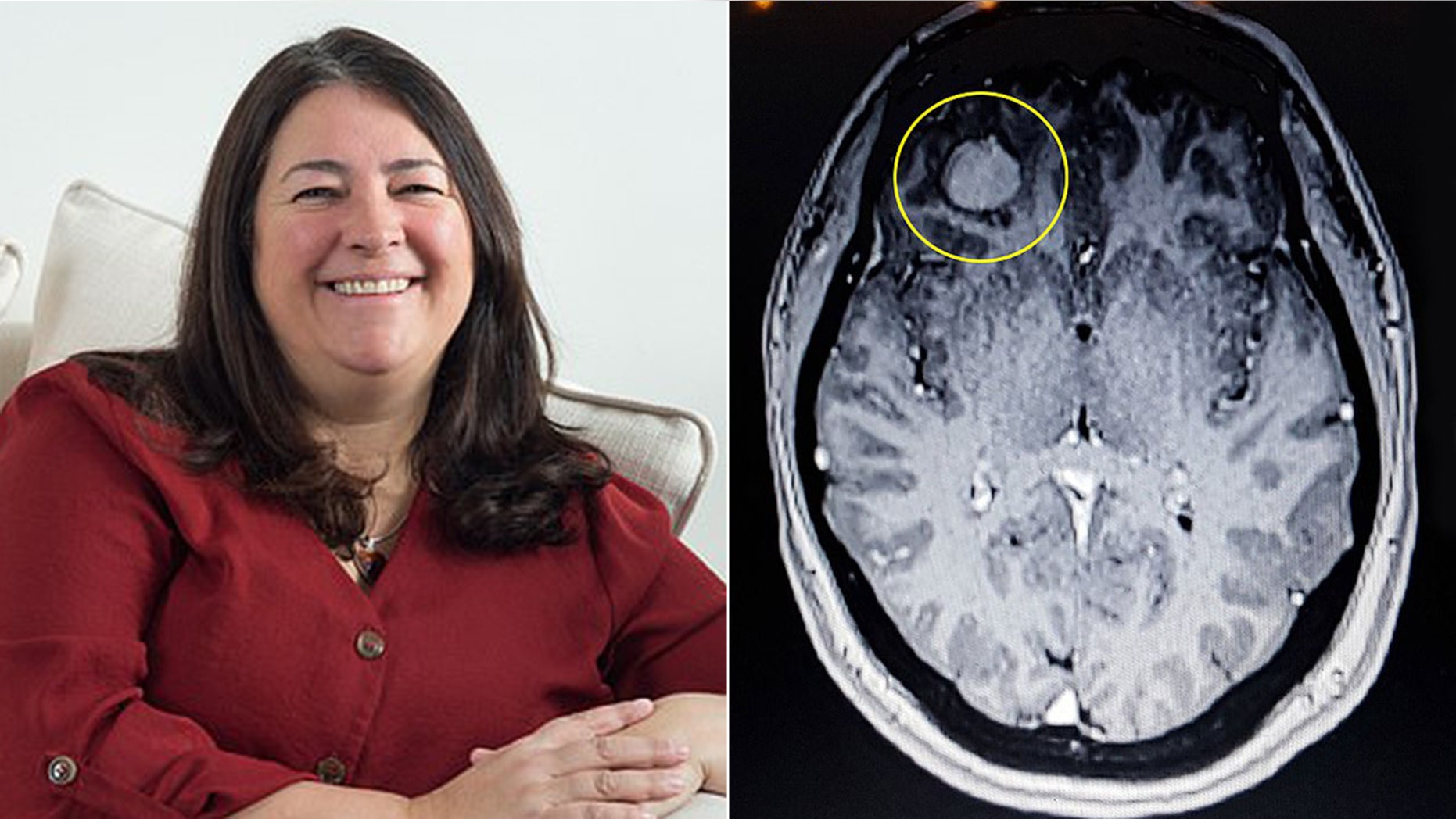 Elaine Lee-Tubby said she went for the MRI to investigate severe headaches following a 2017 car accident, which revealed a tumor had been growing behind her eye.