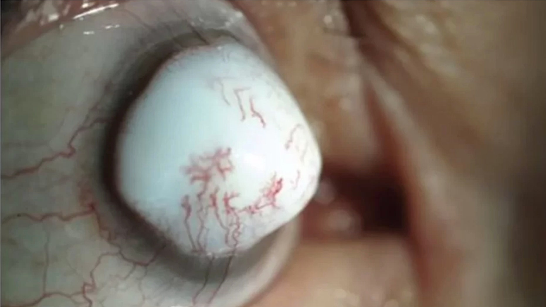 This odd eye problem is the result of a rare lesion on a man's eyeball,