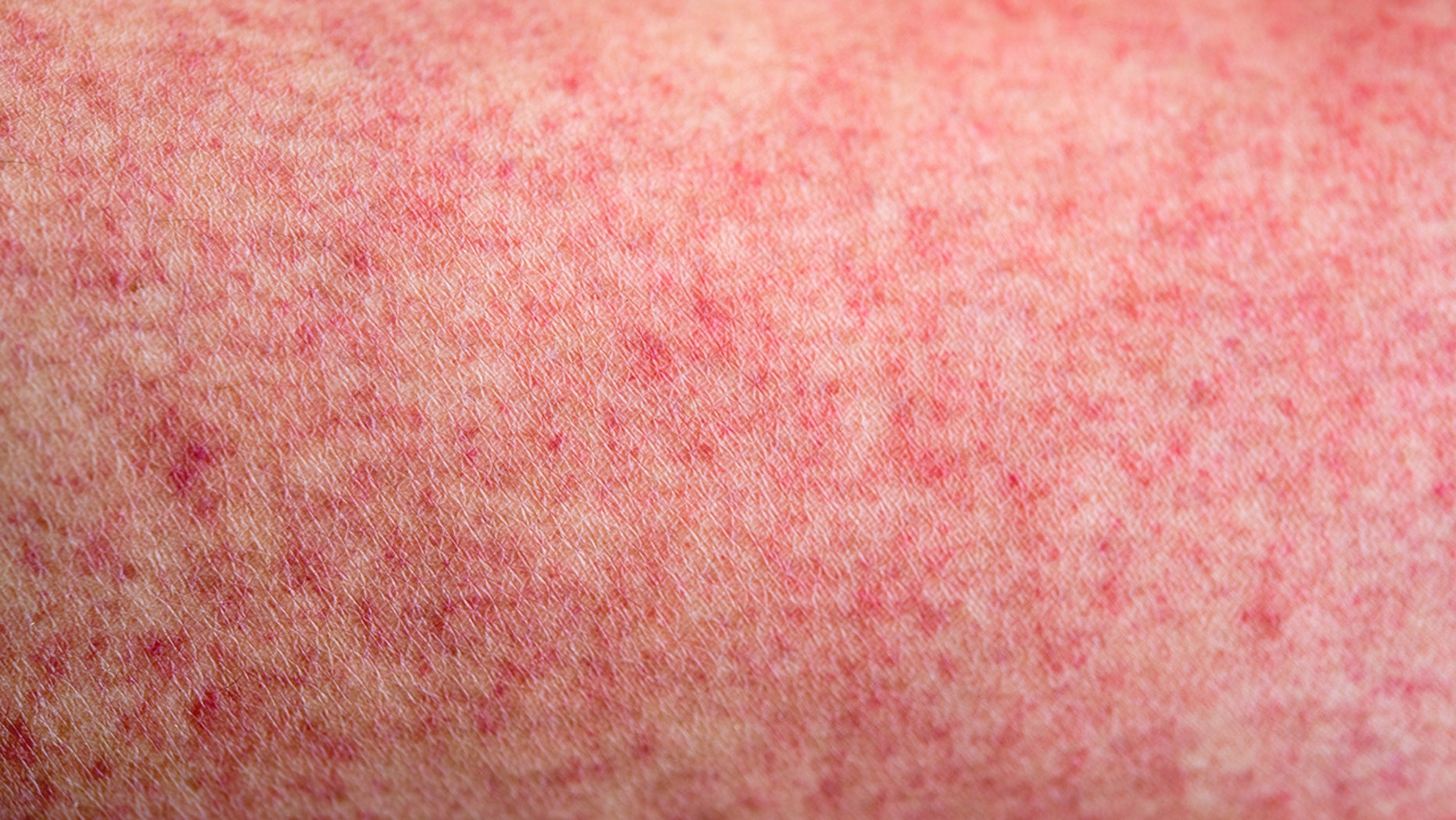 covid rash in adults treatment