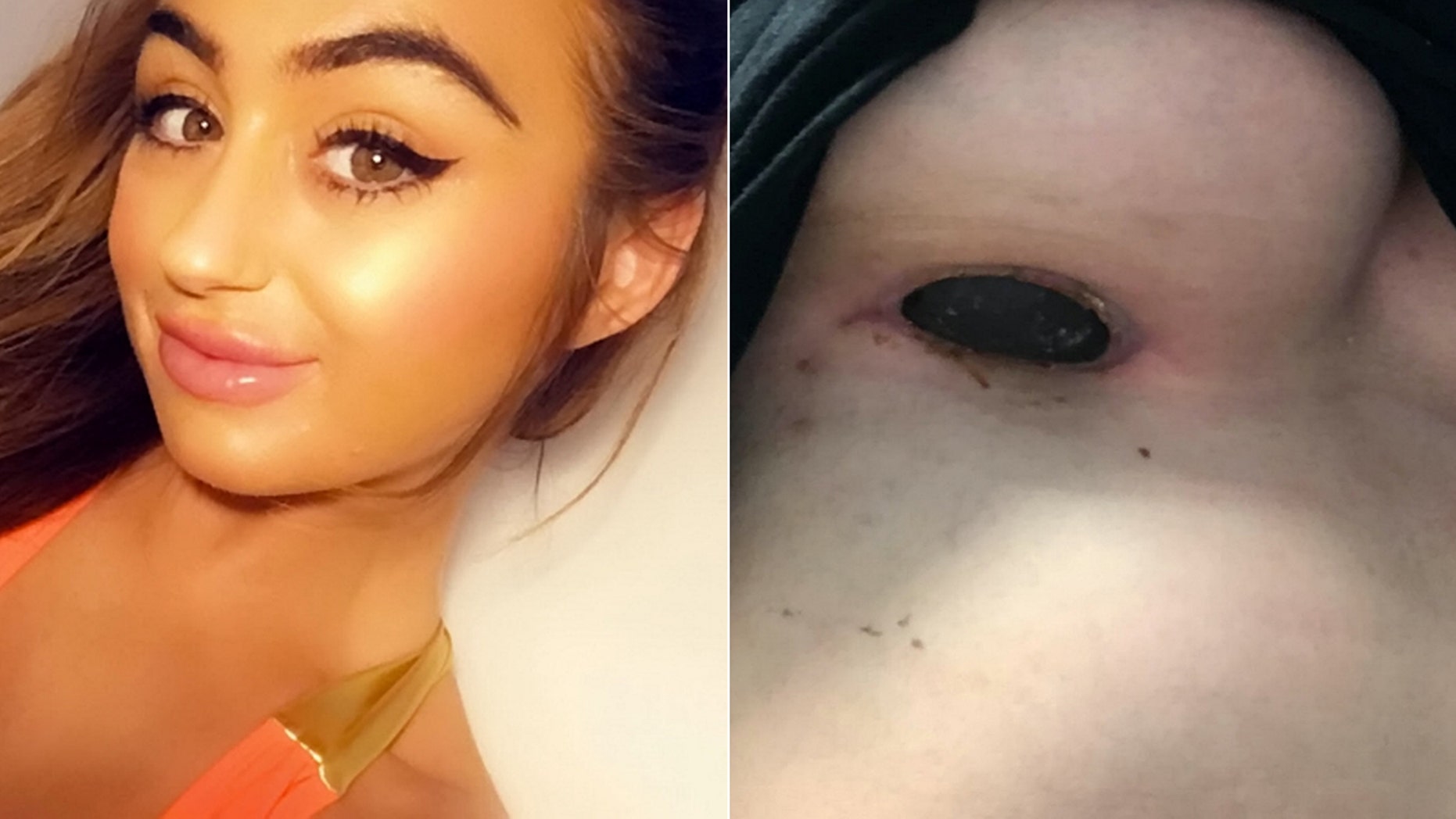 Woman Claims Implant Scar Smelled Like Rotten Meat After Botched Procedure Abroad