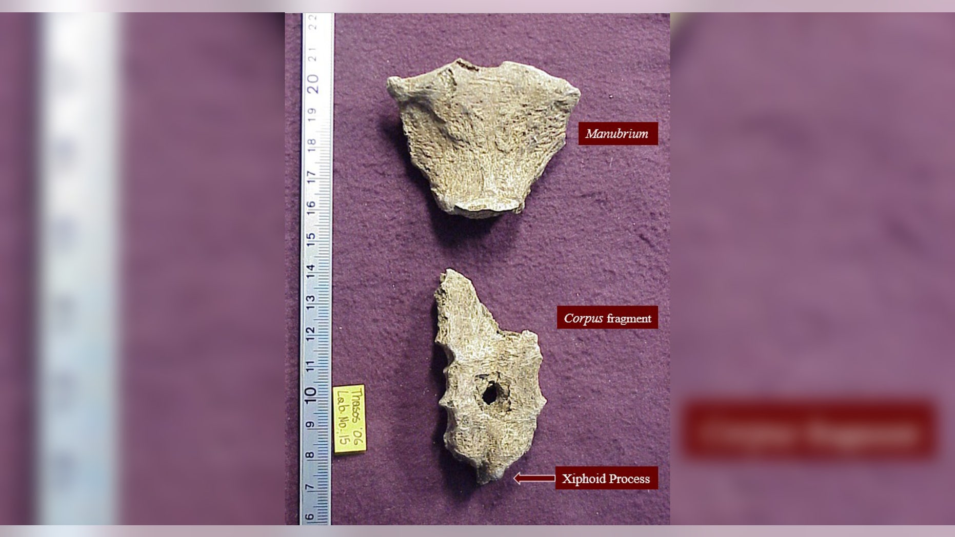 The ancient man's sternum, which has a nearly perfect hole in its center.