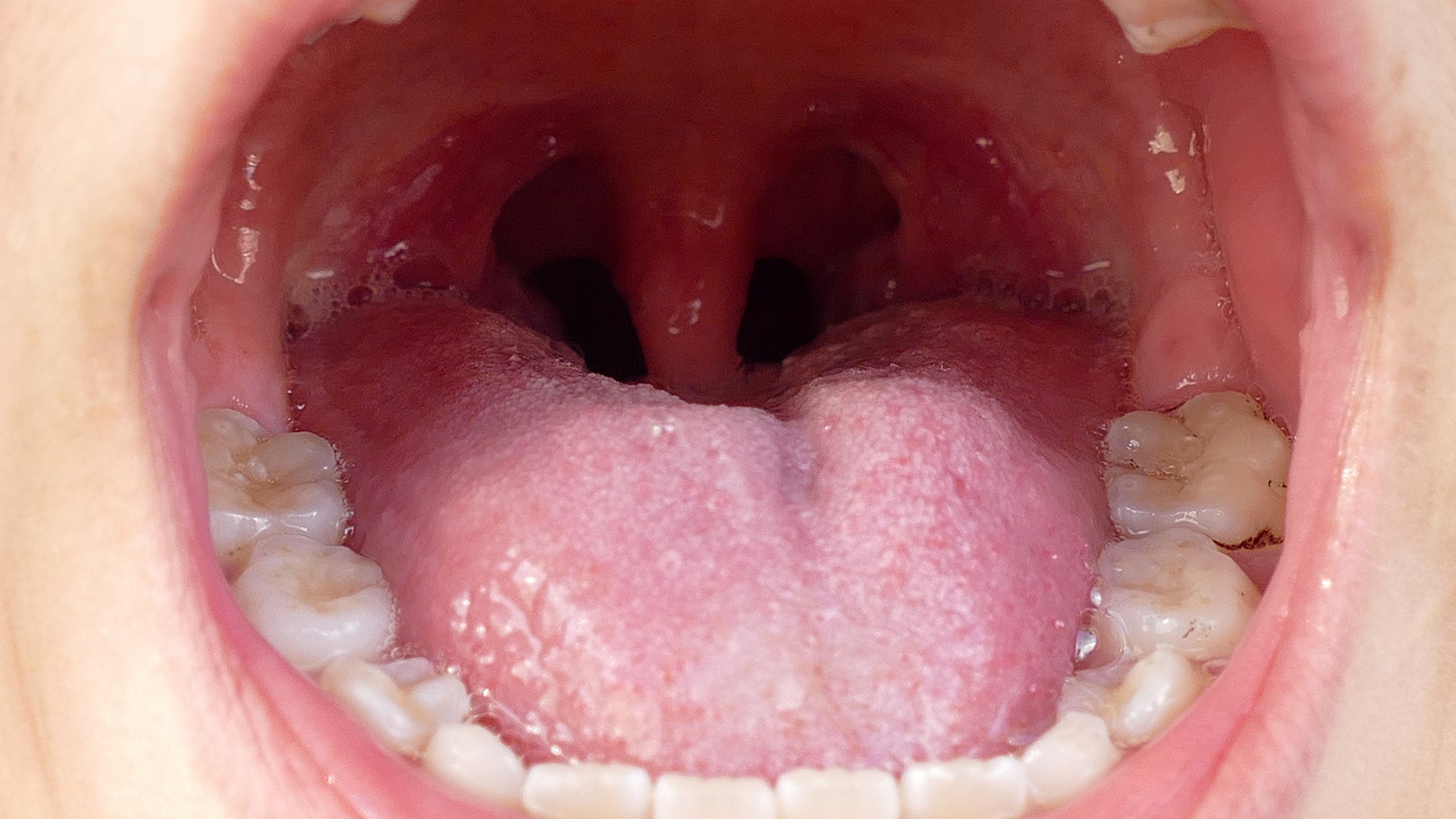 What are tonsil stones — and how do you know if you have them? Fox News