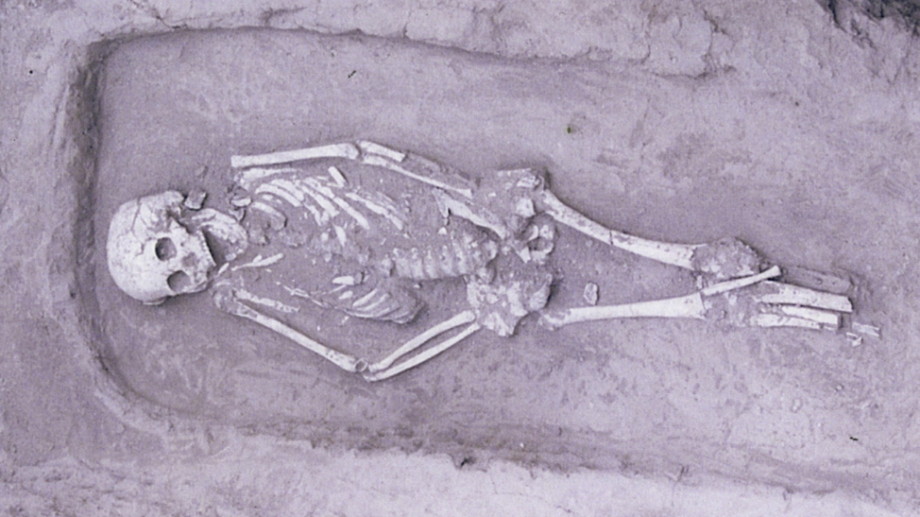 A skeleton found in China belonged to an individual with a rare form of dwarfism. (Credit: Halcrow et al. 2019)