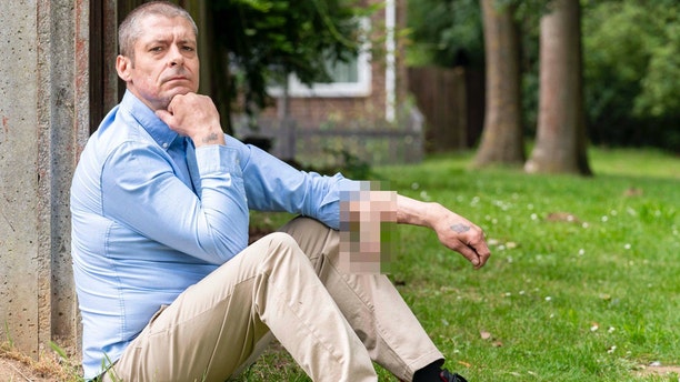 Malcolm MacDonald awaits a surgery to transfer the constructed penis from his arm to its rightful place. (Photo credit MEGA AGENCY)