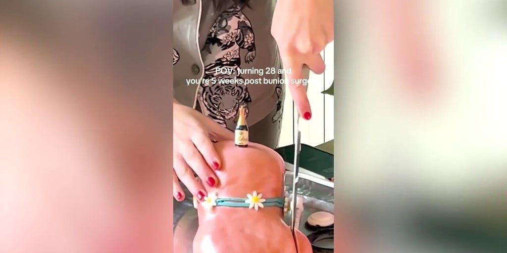 Woman slices bunion off foot-shaped birthday post-surgery