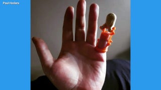 Nebraska man receives 3D-printed finger replacement decades after accident - Fox News