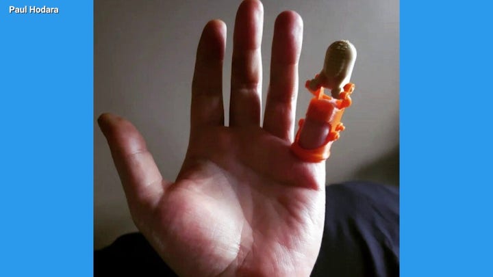 Nebraska man receives 3D-printed finger replacement decades after accident