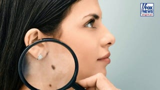 Cancer vaccine cuts melanoma risk nearly 50% in breakthrough study